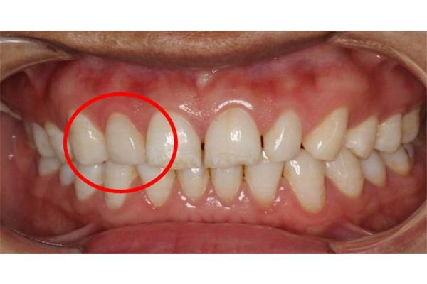 小牙齒怎么修復,小牙齒修復有什么影響?
