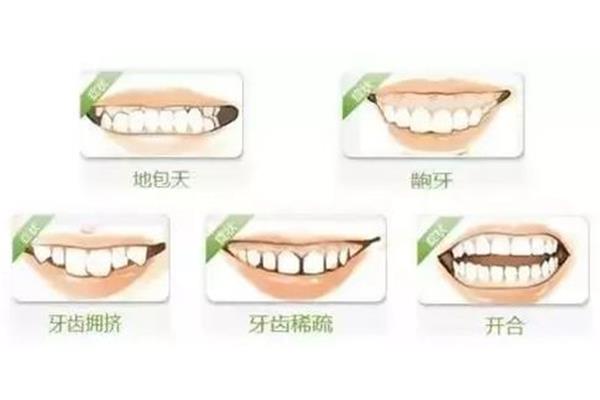 牙齒輕微矯正需要多久,牙齒輕微矯正需要戴多久的牙套?