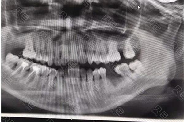 牙囊腫切開后疼多久?牙囊腫被切除了