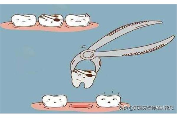 拔牙后多久可以裝假牙,拔牙后多久可以插齒?