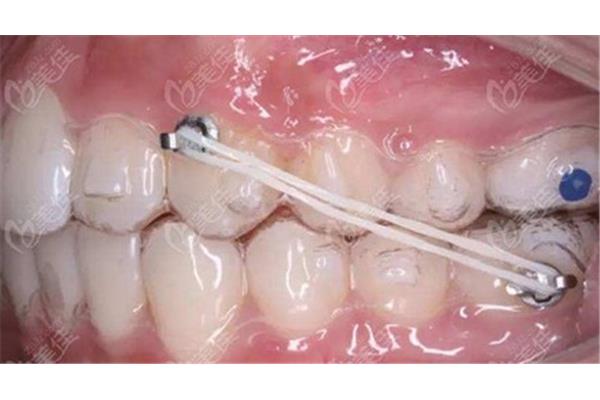 矯正牙齒需要多長時間?什么是隱適美校正?