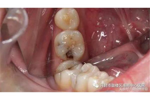 樁冠修復后的牙齒壽命,樁冠修復的牙齒堅固嗎?