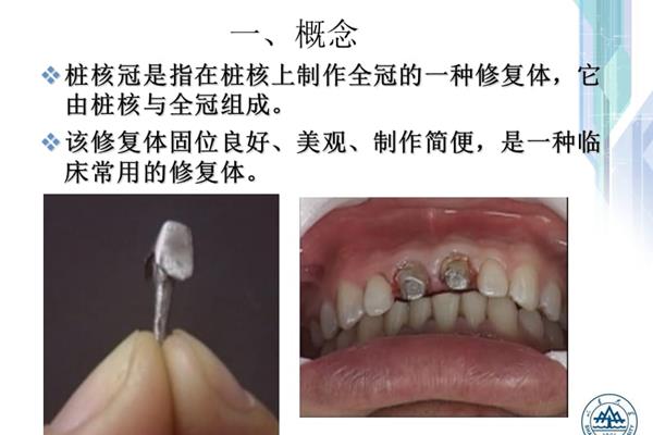 牙科修復體樁核冠修復例,鑄造金屬樁核冠修復工藝