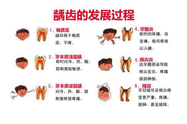 補牙時牙本質過敏會自愈嗎?牙本質過敏治療