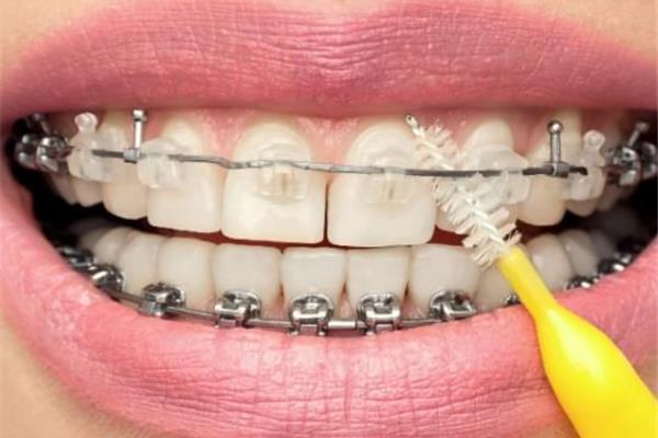 取下牙套的保持器多少錢?不拆牙套可以做固位體嗎?