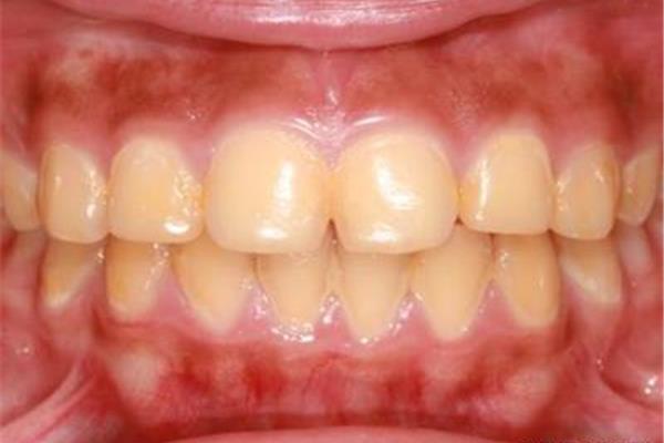 牙齒振動后多久變色,根管治療后多久變色?