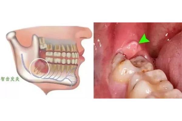 局部牙槽膿腫多久能治好?牙齒膿腫不切開多久能自愈?
