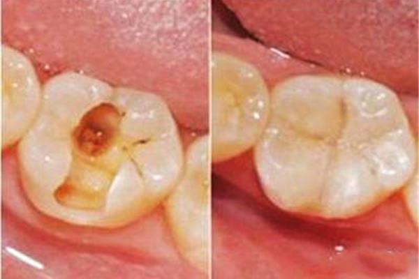 牙髓炎補牙要多久