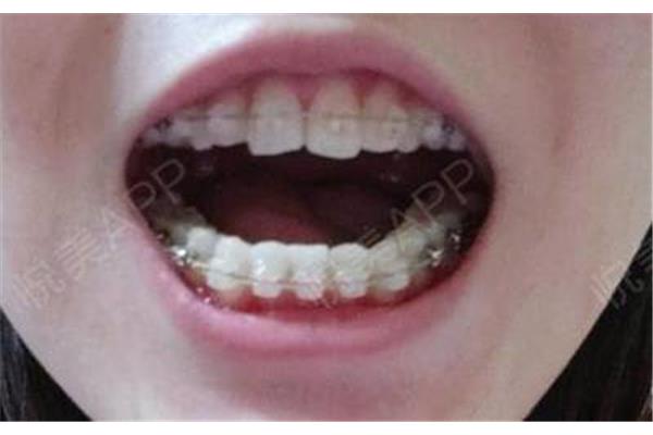 你多久調整一次牙齒?矯正牙齒需要多長時間?