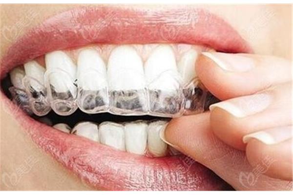 戴透明牙套需要多久,做牙套需要多久?