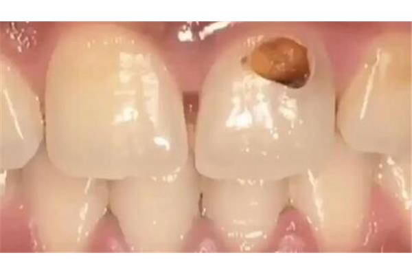 門牙折斷后多久可以補牙