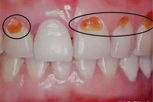 斷牙多長時間可以重新接上再接上?