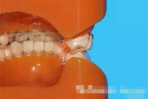 兒童矯正錯牙合畸形需要多長時間,如何矯正后牙閉鎖?