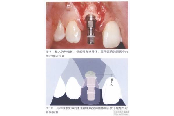 口腔拔牙傷口需要多長時間愈合,拔牙需要多長時間恢復?