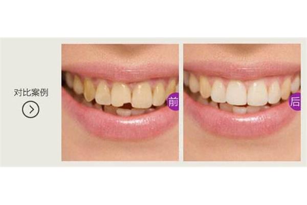 如何修復門牙和瓜子,光固化樹脂補牙的步驟