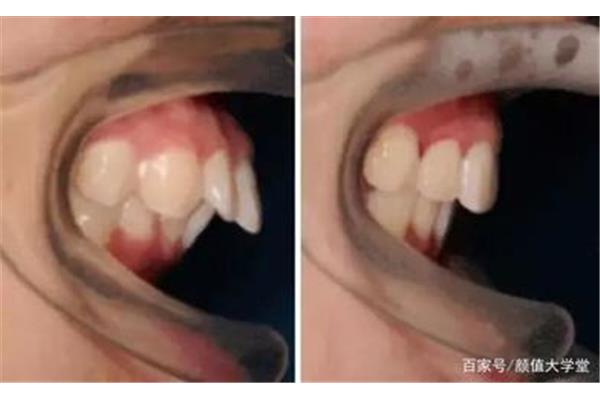 根管后的牙齒可以用多久?根管治療后的牙齒可以用多久?