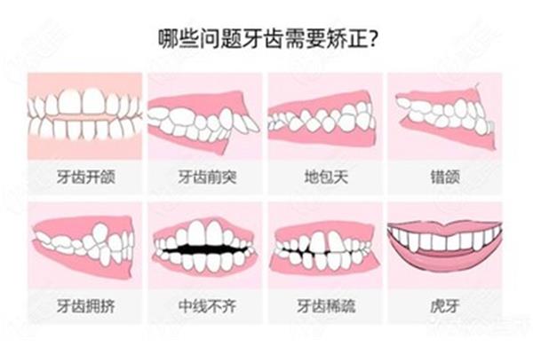 牙套應該戴多久,多久能看到效果?