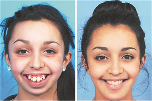 牙齒矯正需要多久才能看到效果,做牙齒矯正需要多久?