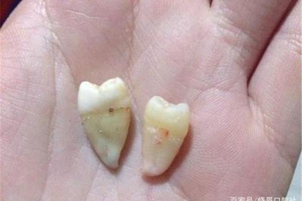 拔牙后多久可以戴假牙,拔牙后多久可以戴假牙?
