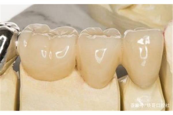 牙齒裝假牙多久能好,牙多久能長出來?