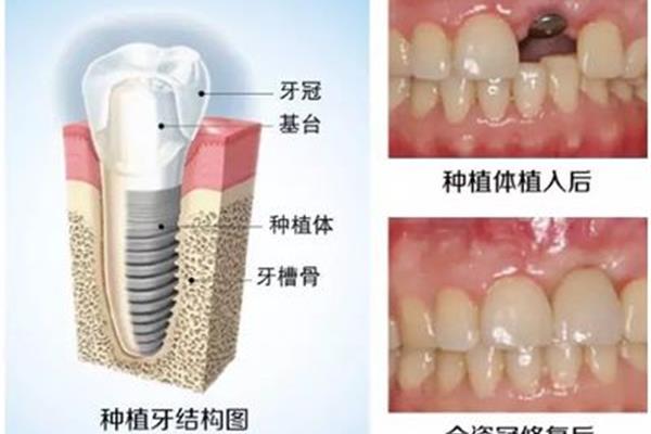 拔牙后折斷的牙槽骨和智齒拔除后的牙槽骨需要多長時間恢復?