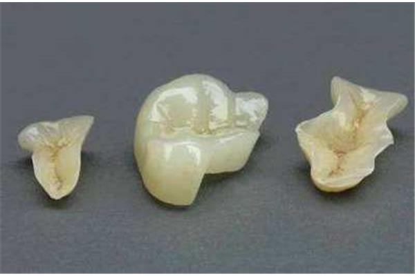 復合樹脂嵌體、嵌體和烤瓷牙有什么區別?