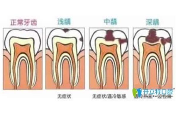 牙痛吃什么好?牙髓炎疼痛會持續多久?
