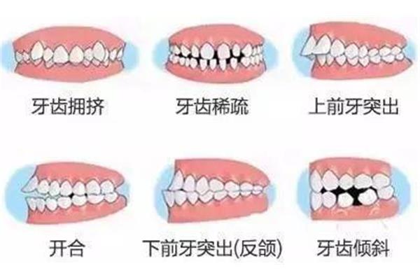 牙齒矯拔牙需要多久