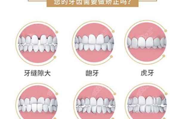 牙齒正畸一般需要多長時間?口腔正畸專業是什么?