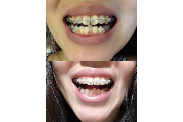 帶牙套的牙齒能一起長多久,瓷牙套能長多久?
