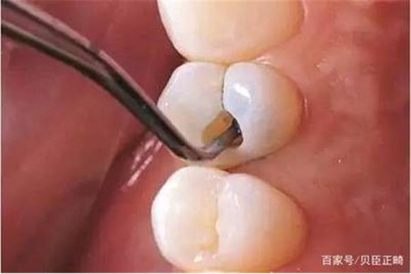 補牙后可以正常咬合多久,樹脂補牙沒有咬合面可以用多久?