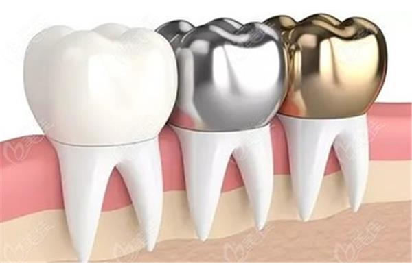 求幫助關于根管治療,關于根管治療后做牙套
