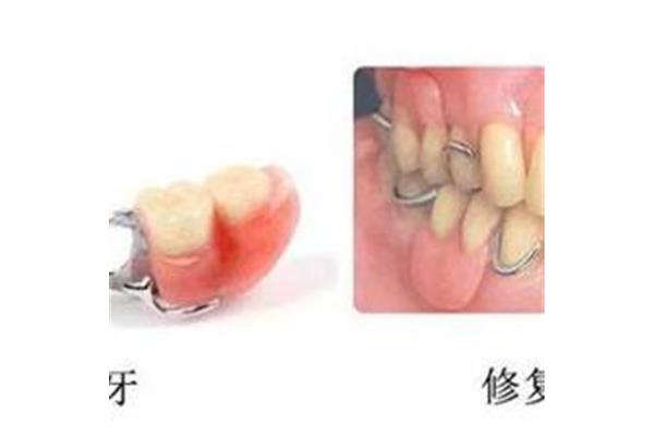 義齒每天要戴多久才能矯正牙齒的傷害