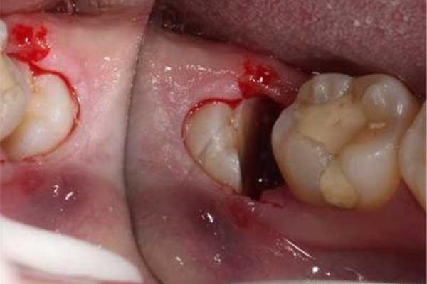 拔牙傷口需要多久才能愈合,拔牙傷口需要多久才能愈合?