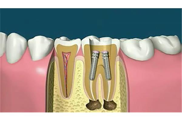 纖維樁修復牙齒可以用多久,做完纖維樁可以當牙冠用多久?