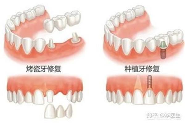種植牙齒能保留多久多久
