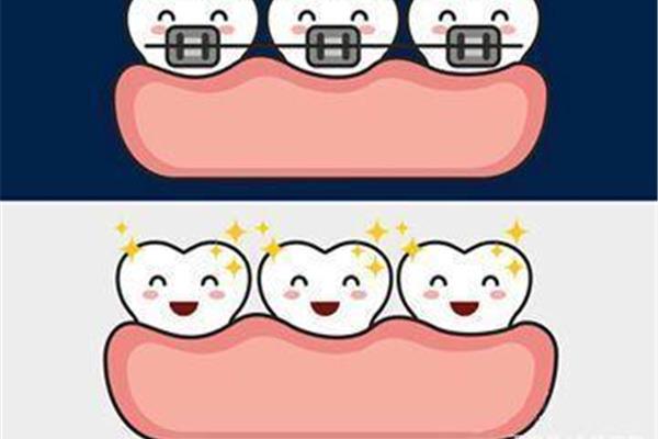 正畸后疼痛會持續多久?你做牙齒矯正多久了?