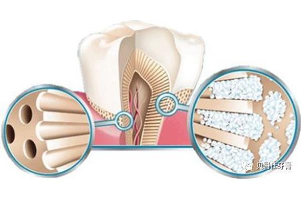 矯正牙齒做好牙模后要等多久才能緩解牙結石的痛苦?