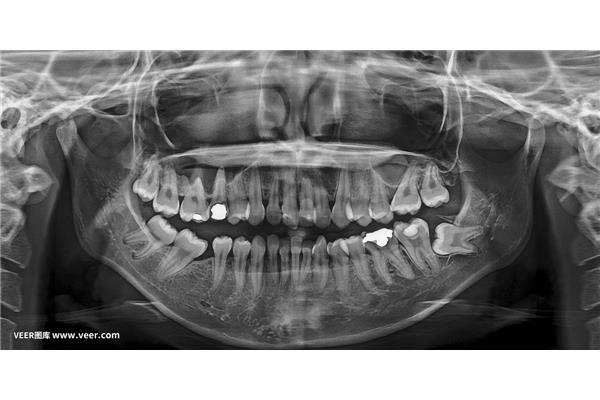 牙科x光片的輻射劑量是多少(急),牙齒矯正全過程有哪些步驟?