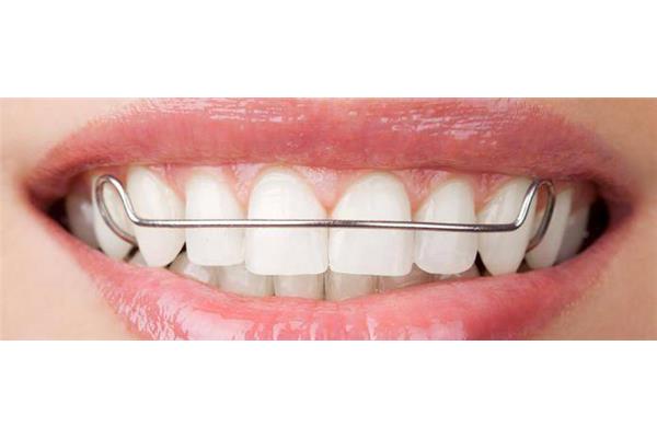 牙套的固位體需要多長時間,正畸的齙牙如何回縮?