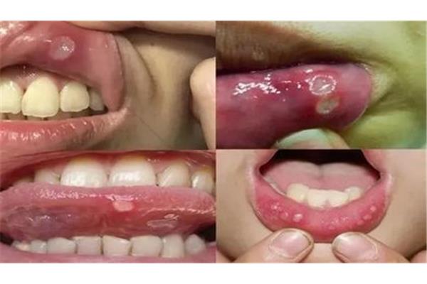 外傷牙松動恢復需要多長時間?外傷牙磕疼
