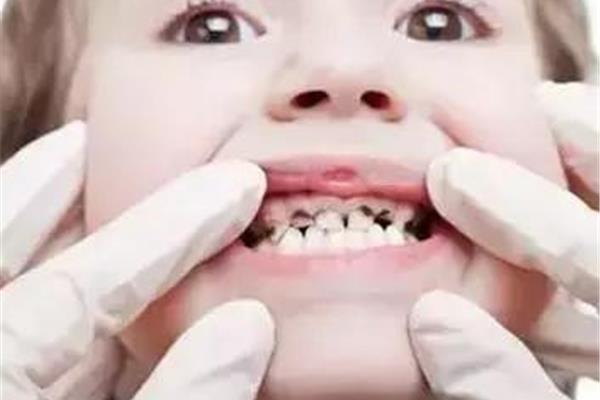 牙齒治療后多久可以補牙,牙齒治療后多久可以生孩子?