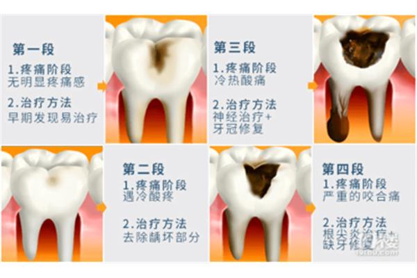 補過的牙可以用多久?杭州上城城北口腔醫院有限公司