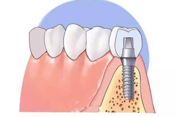 種植牙后如何護理,安裝種植牙后需要注意什么?