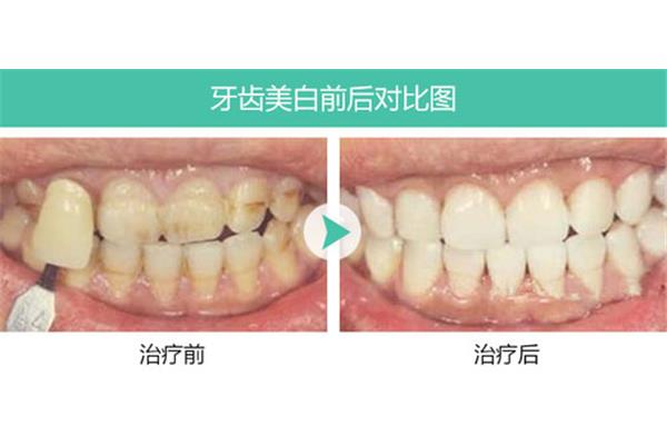 牙齒涂料美白能持續多久,牙膏美白能持續多久?