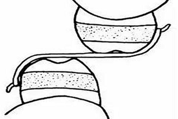 上下牙交互牽引和上牙牽引的錯畸形矯正視頻