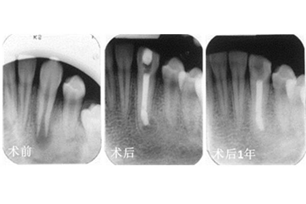 牙齦成形術后多久可以修復
