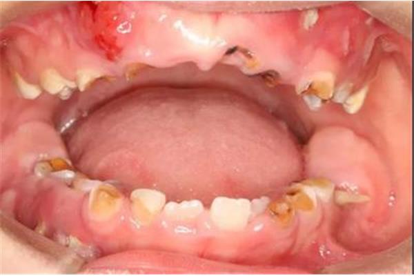 齲齒怎么辦?如何治療乳牙齲齒?