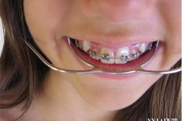 戴正畸牙套多久?成年人戴正畸牙套有用嗎?