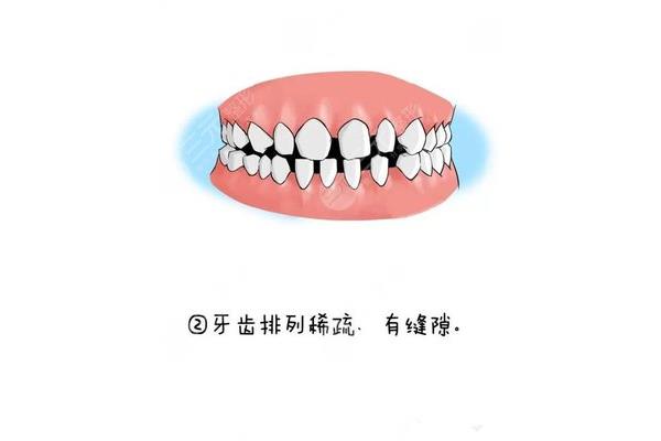 戴牙套后能吃多久,戴牙套后能嚼多久?